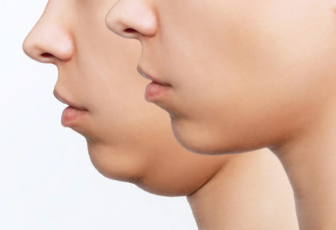 Cheek & Chin Reshaping Surgery in Delhi | Dr. Anubhav Gupta