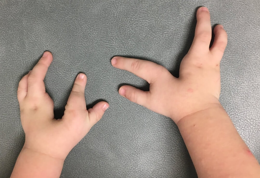 One Finger Missing Congenital Hand Syndrome - Plastic Surgery Delhi