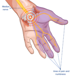 carpel tunnel syndrome treatment in delhi