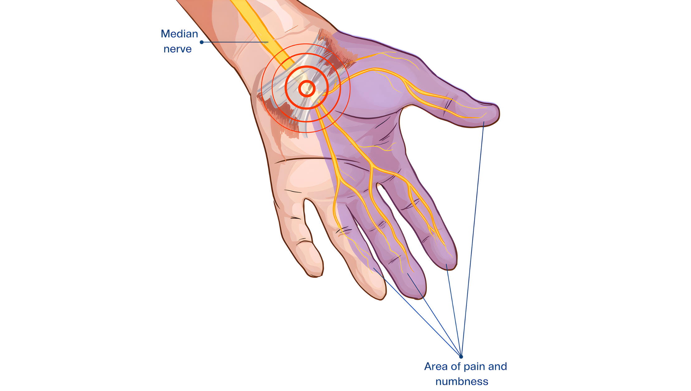 carpel tunnel syndrome treatment in delhi