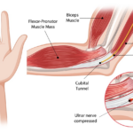 Ulnar Nerve Palsy : Causes, symptoms, treatment by Dr. Anubhav Gupta
