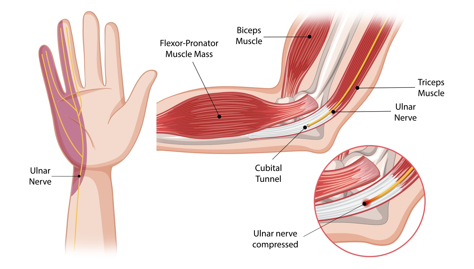Ulnar Nerve Palsy : Causes, symptoms, treatment by Dr. Anubhav Gupta