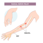 Radial Nerve Palsy Treatment | Dr. Anubhav Gupta