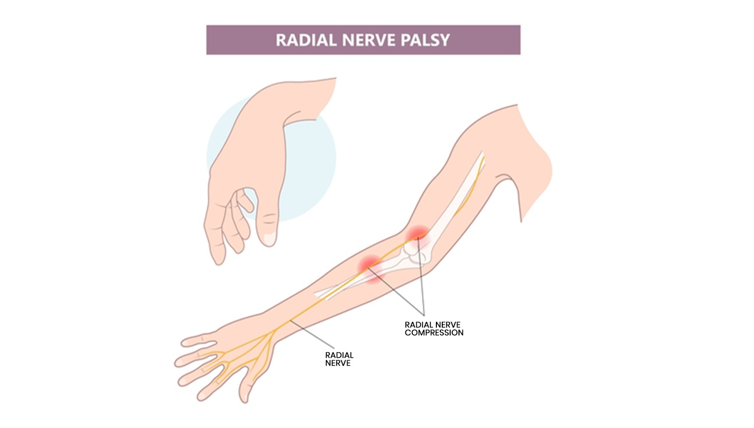 Radial Nerve Palsy Treatment | Dr. Anubhav Gupta
