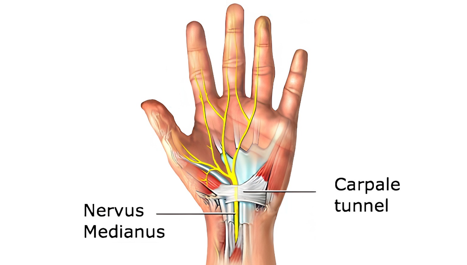 Carpal Tunnel Syndrome Treatment in Delhi: Causes, Symptoms & Best Solutions
