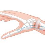 Radial Nerve Damage Symptoms & Best Nerve Specialist in Delhi