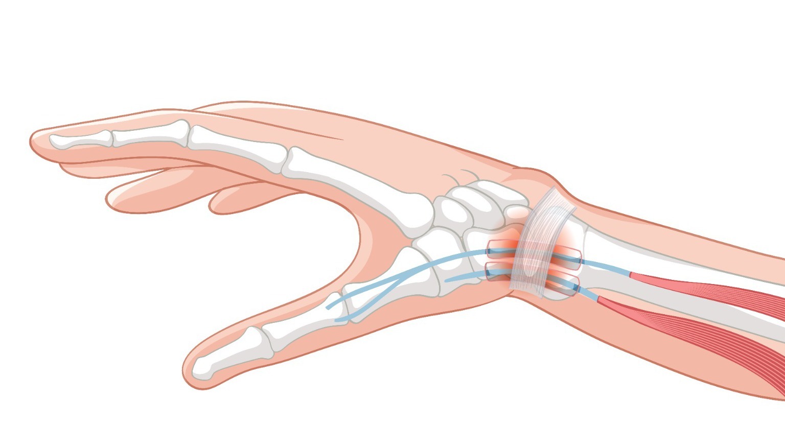 Radial Nerve Damage Symptoms & Best Nerve Specialist in Delhi
