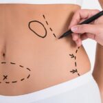 Liposuction Treatment in Delhi