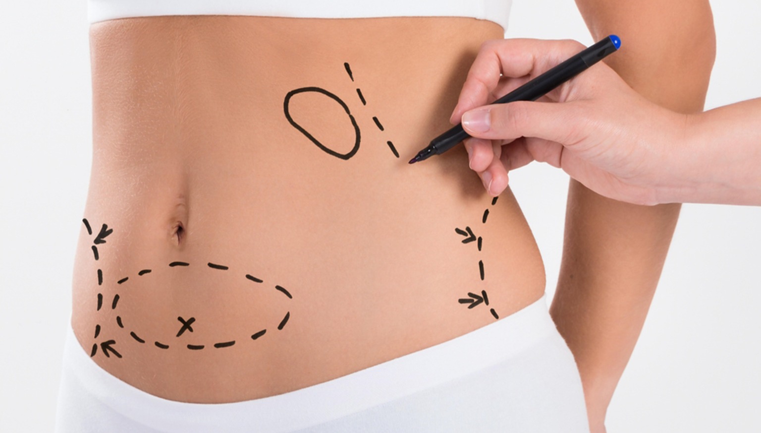 Liposuction Treatment in Delhi