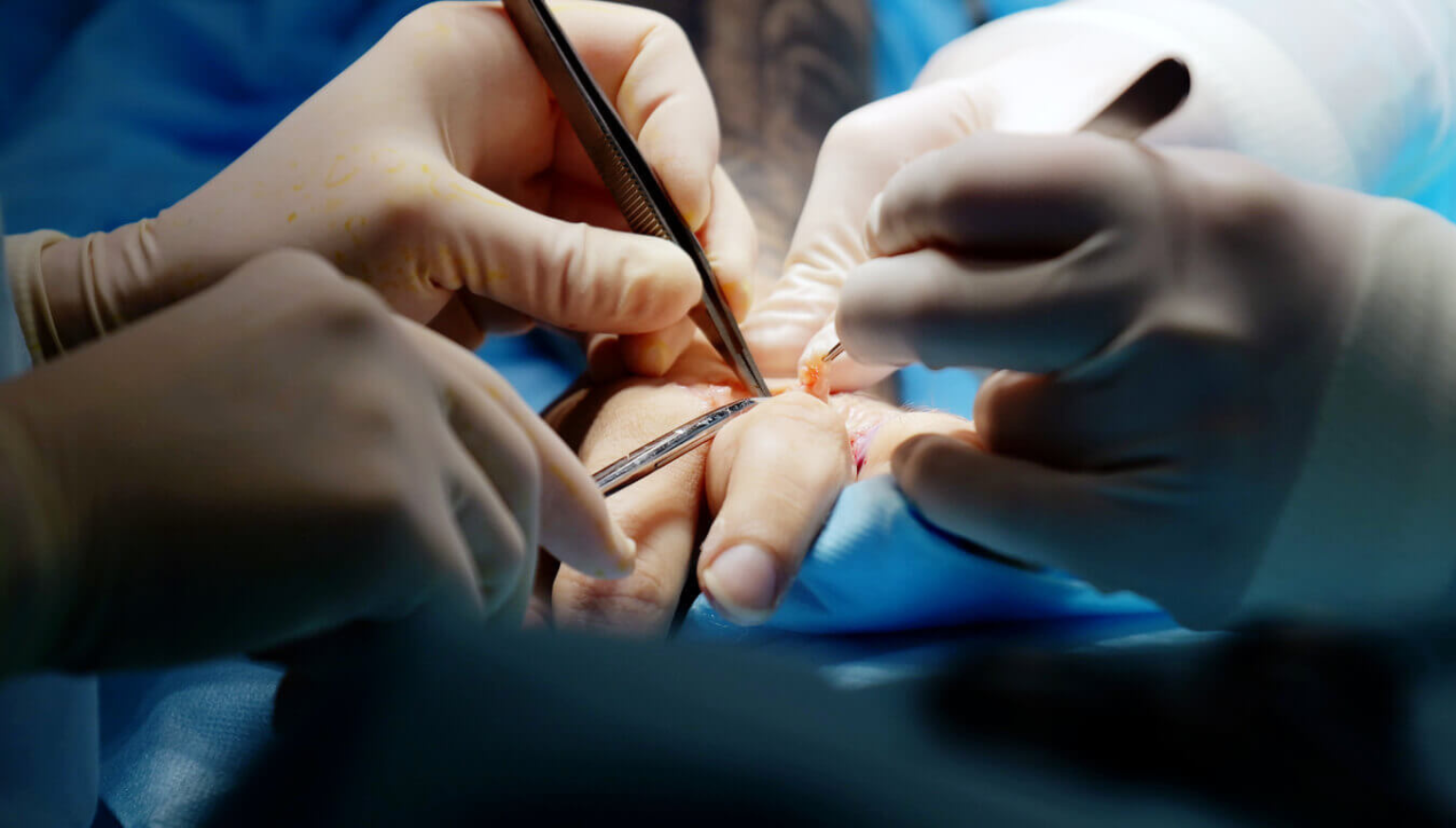 Best Hand Specialist in Delhi for Hand Injuries, Fractures and Nerve Problems