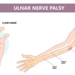 Ulnar Nerve Palsy Treatment in Delhi