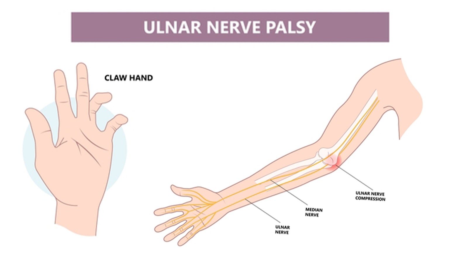 Ulnar Nerve Palsy Treatment in Delhi