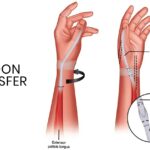 tendon transfer surgery