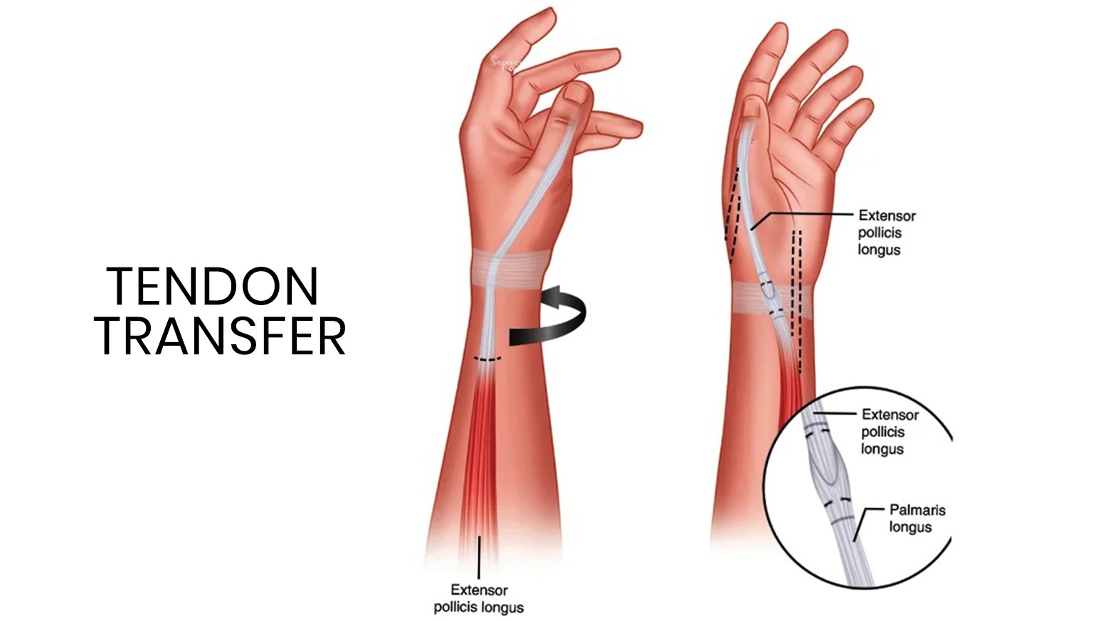 tendon transfer surgery