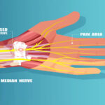 median nerve palsy treatment