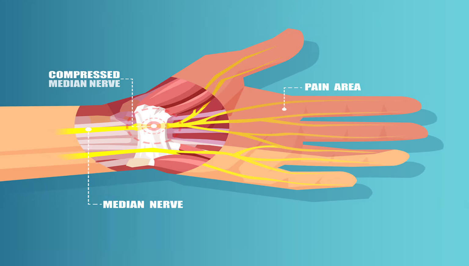 median nerve palsy treatment
