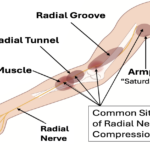 Radial Nerve Palsy Treatment: Causes, Symptoms, Recovery & Best Doctor