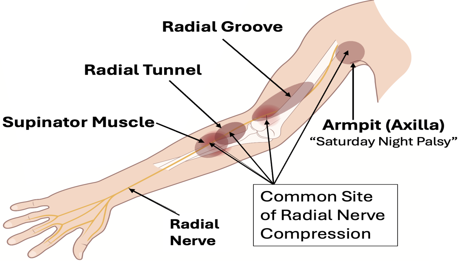 Radial Nerve Palsy Treatment: Causes, Symptoms, Recovery & Best Doctor