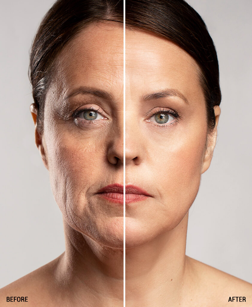 face lift surgery before and after