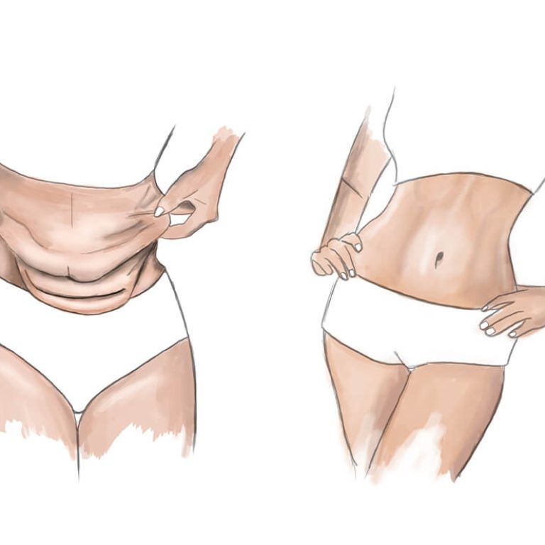 Abdominoplasty or Tummy Tuck Surgery in Delhi | Dr. Anubhav Gupta