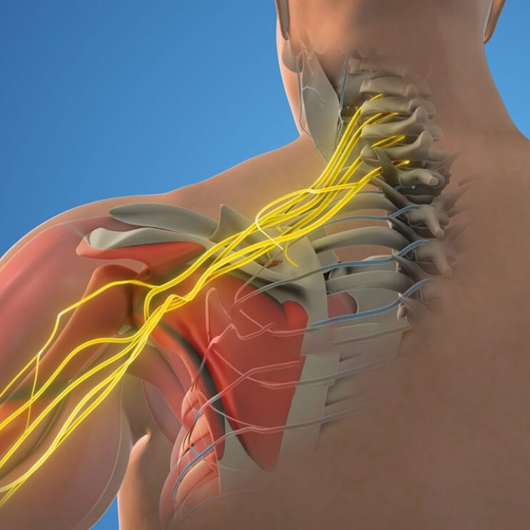 Adult Brachial Plexus Palsy Surgery in Delhi