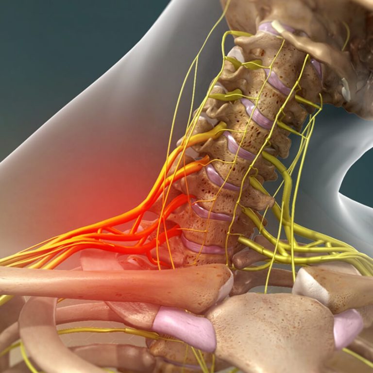 BRACHIAL-PLEXUS-INJURY