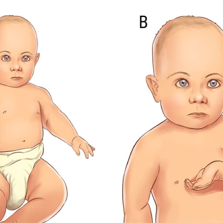 birth related brachial plexus palsy surgery in delhi