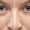 Blepharoplasty