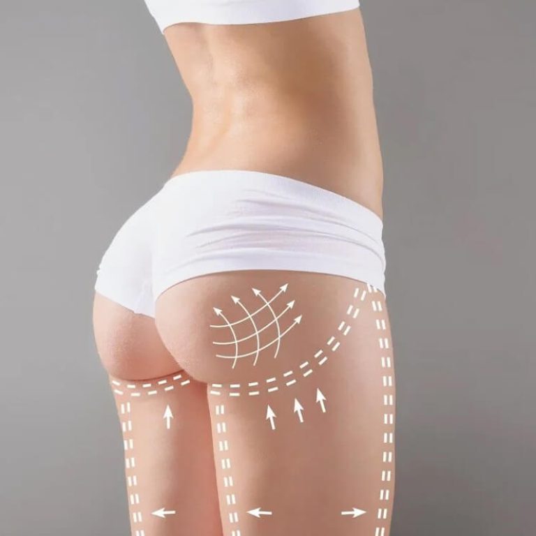 Body Contouring Surgery in Delhi