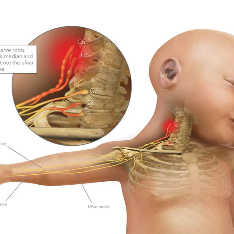 Best Brachial plexus surgery in Delhi