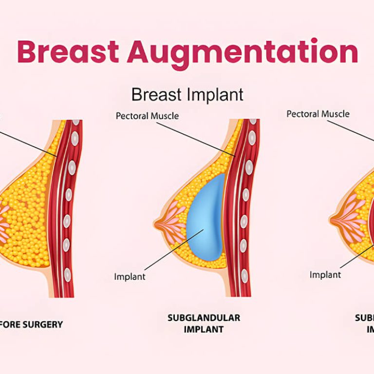 Breast Augmentation Surgery in Delhi