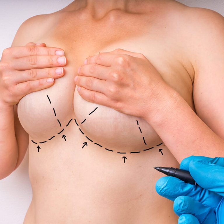 Breast Reduction Surgery in Delhi, India
