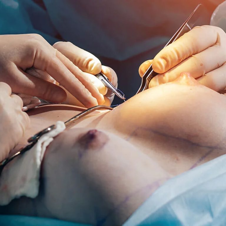 Best Breast surgery in delhi | Breast Surgeon in delhi Dr. Anubhav Gupta