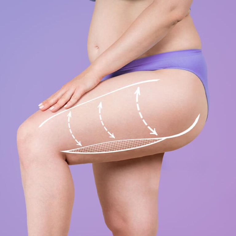 Thigh Lift Surgery in Delhi