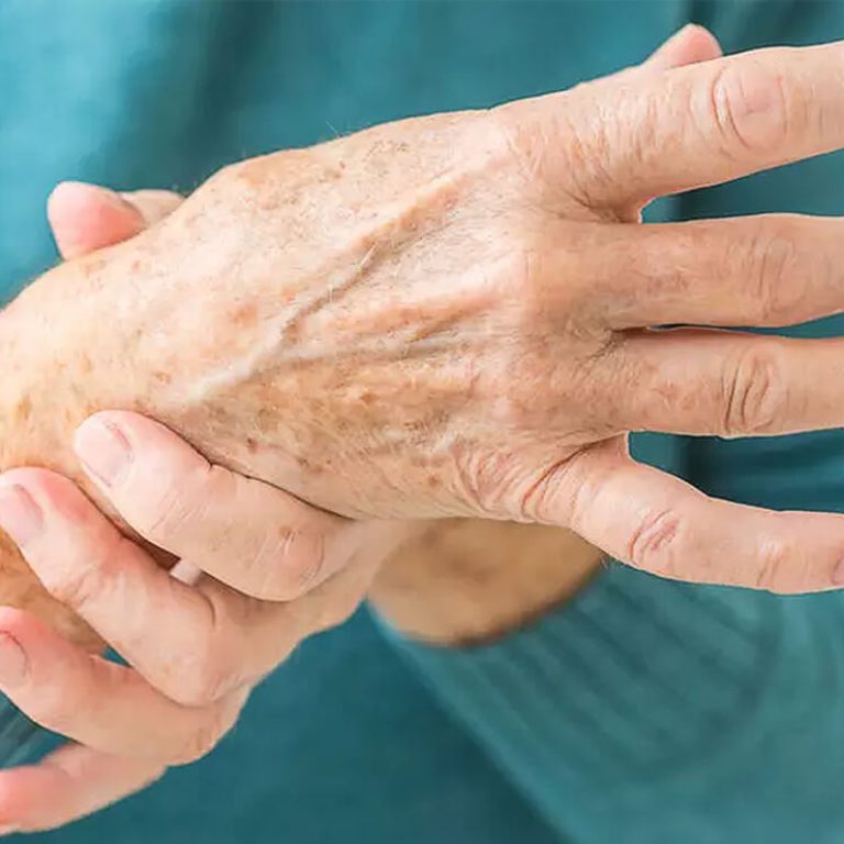 Carpal Tunnel Syndrome Treatment in Delhi | Dr. Anubhav Gupta