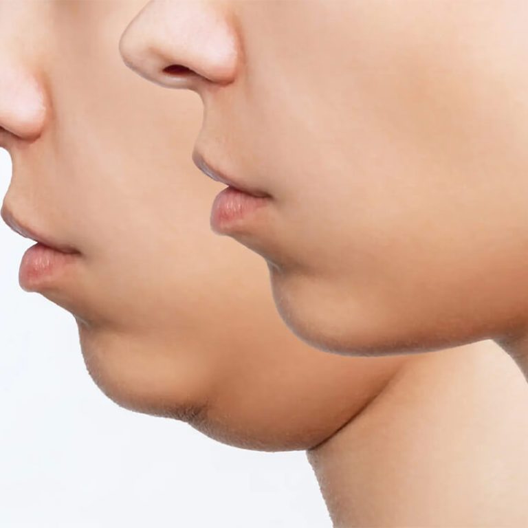 cheek & Chin Reshaping Surgery in Delhi