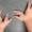 Congenital-Hand-Syndrome