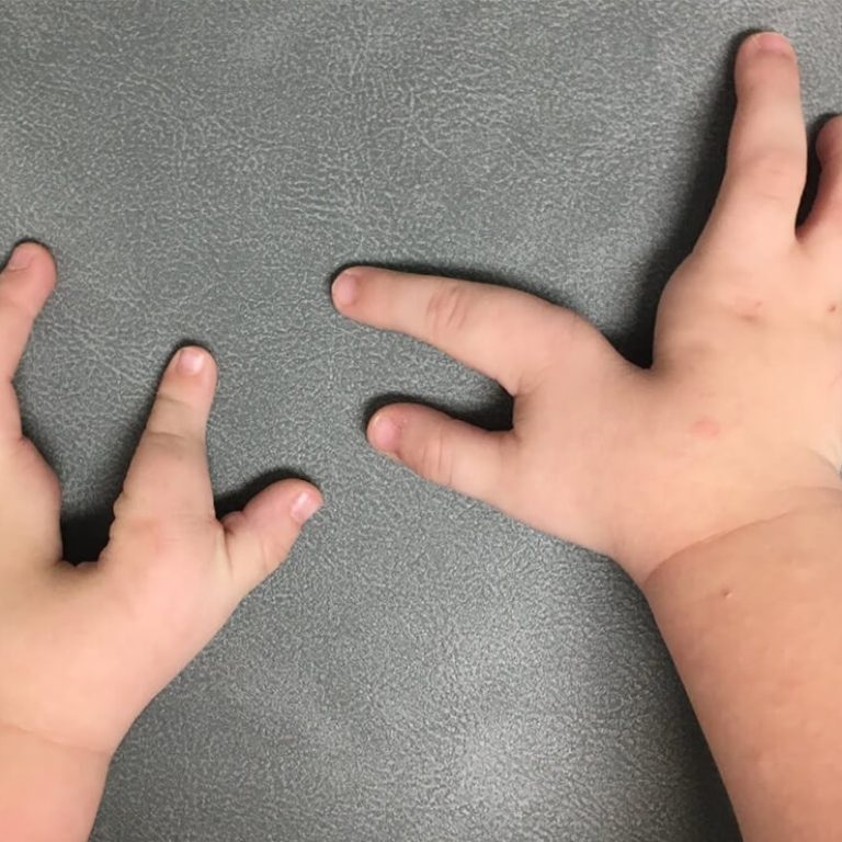 Congenital-Hand-Syndrome