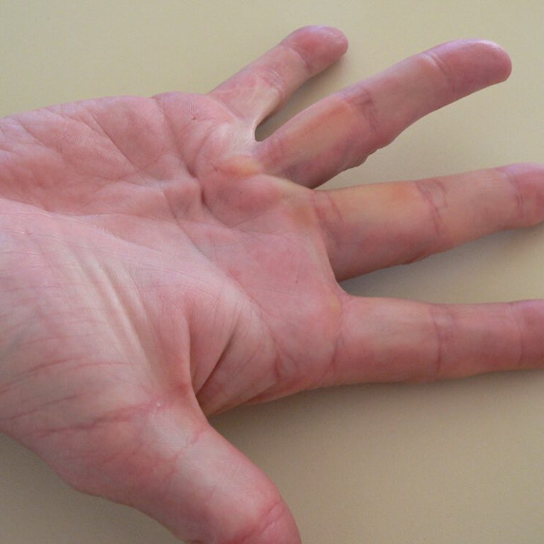 Dupuytren’s-contracture