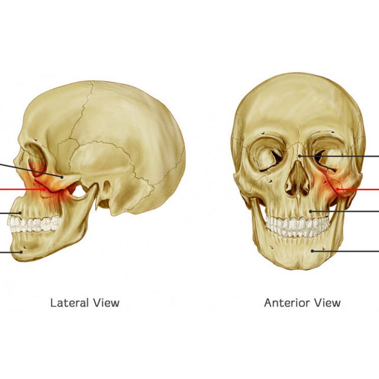 Facial Bone Fracture Treatment in Delhi by Anubhav Gupta