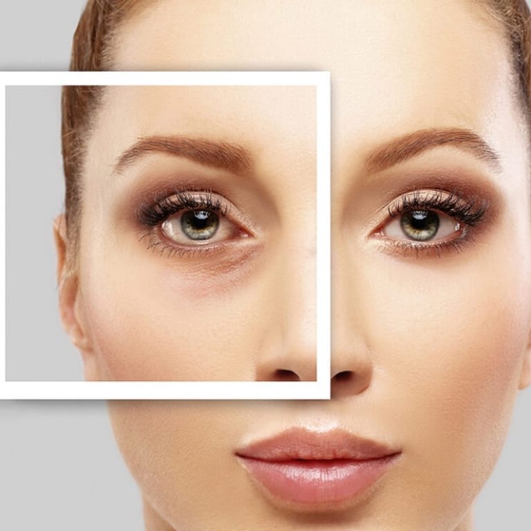 Facial Fat Grafting in delhi - Fat Injection