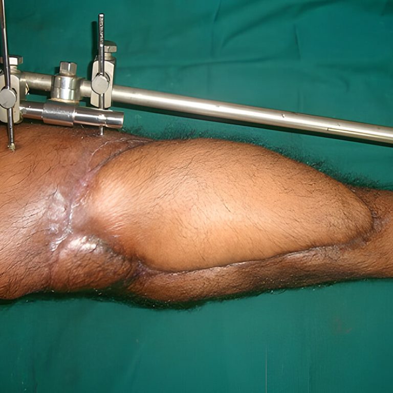 Limb Trauma Treatment in Delhi by Anubhav Gupta