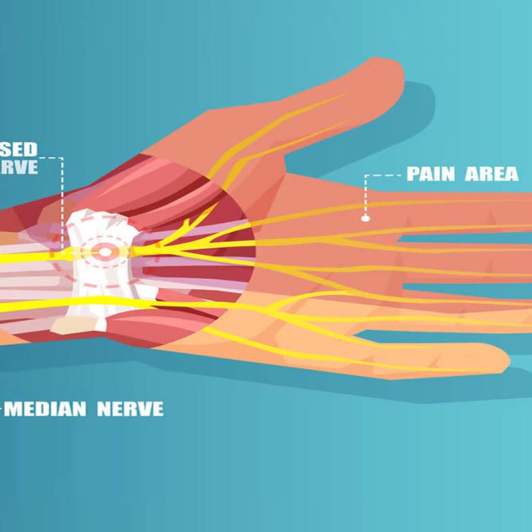 median nerve palsy treatment