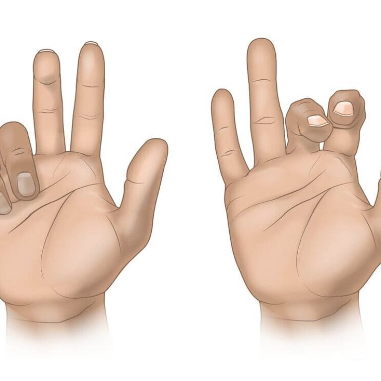 Median Nerve Palsy Treatment in Delhi | Dr. Anubhav Gupta