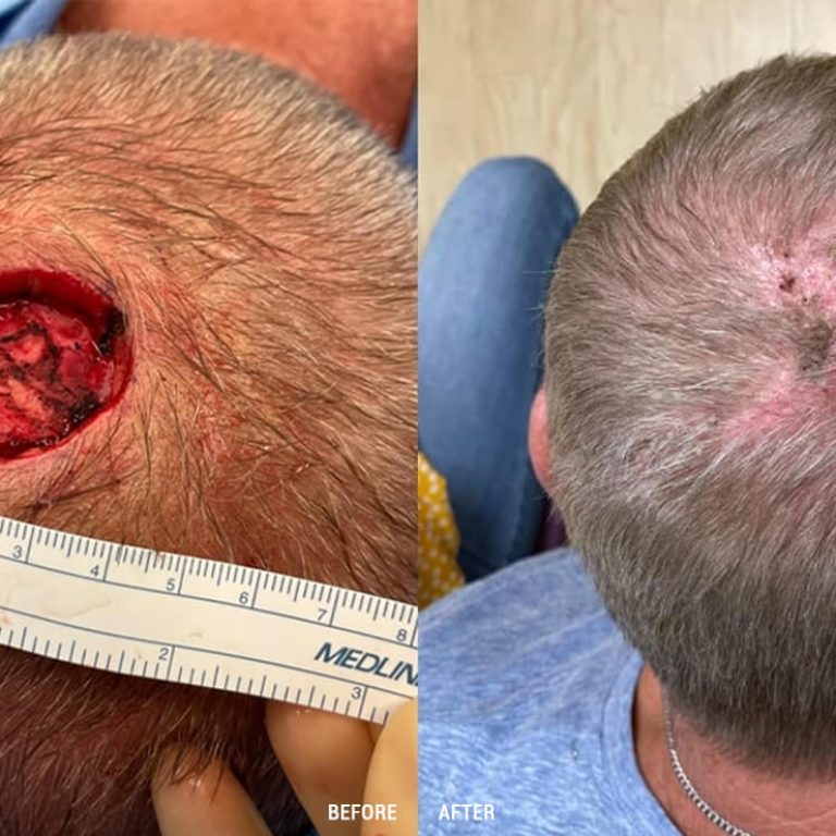 Post Cancer Reconstruction in Delhi | Dr. Anubhav Gupta