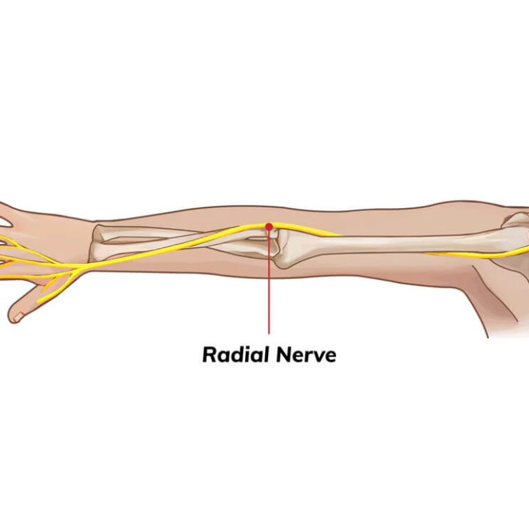 Radial Nerve Palsy Treatment in Delhi