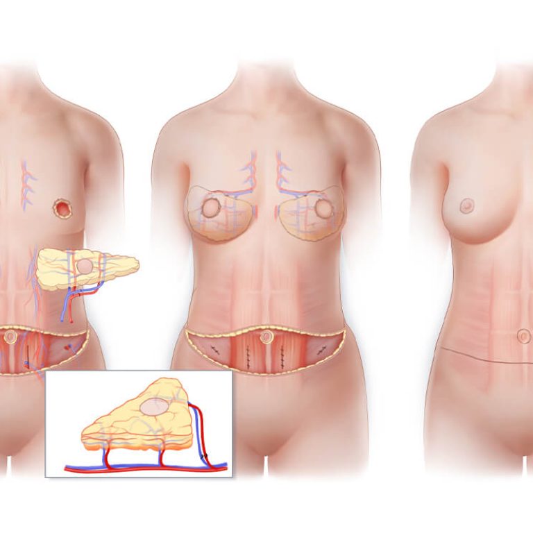 Reconstructive Plastic Surgery in Delhi