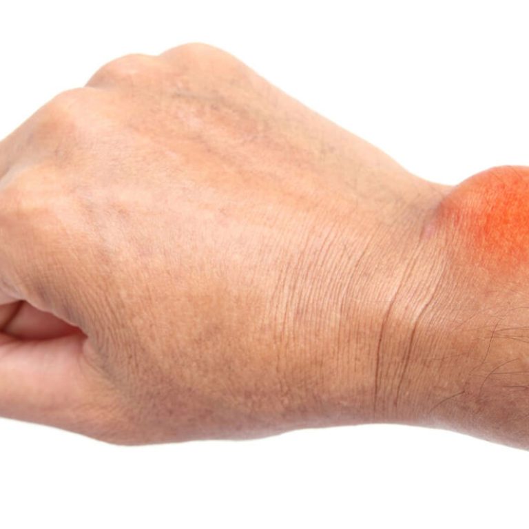 Hand Swelling & Tumor Treatment in Delhi - Dr. Anubhav Gupta