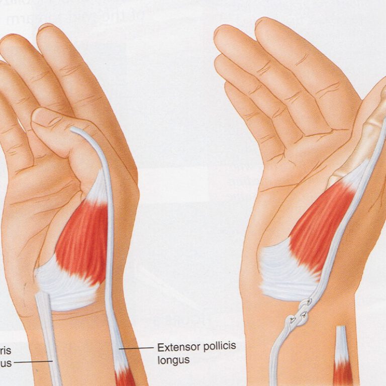 Tendon Transfer Surgery in Delhi