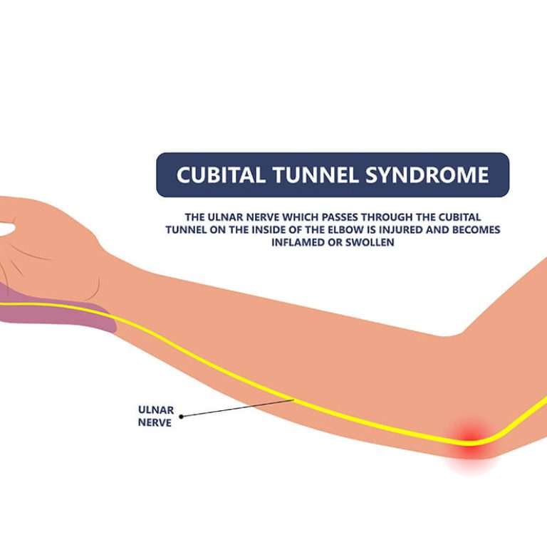 Ulnar Nerve Palsy Injury Treatment in Delhi | Dr. Anubhav Gupta